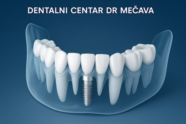 Položaj implantata u vilici